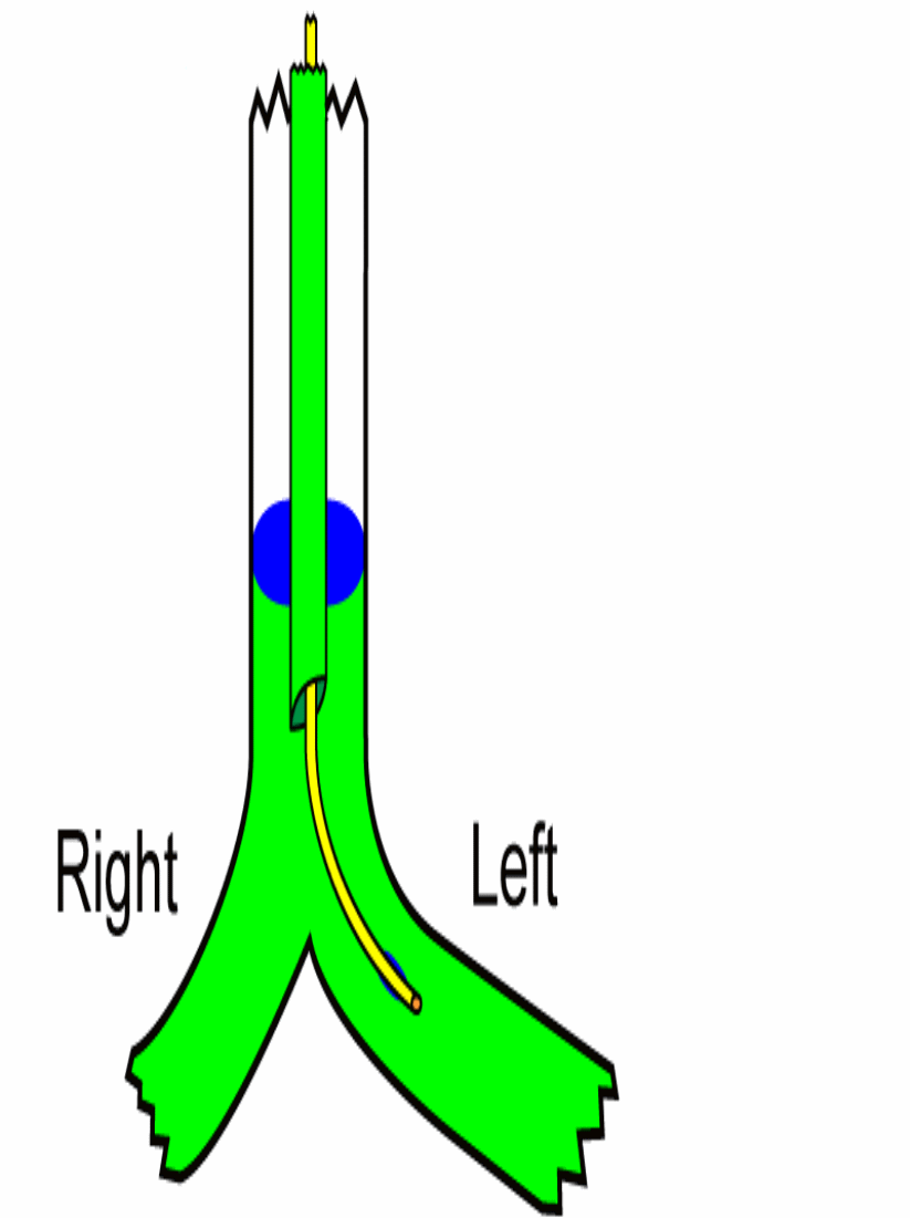 bronchial blocker insertion