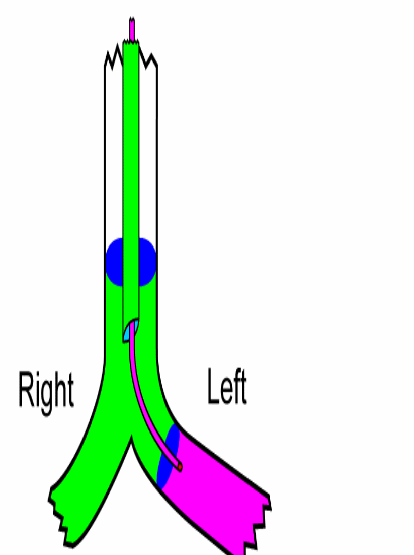 bronchial blocker inflated